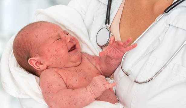 Measles: Its Host factors,symptoms and Prevention in Children