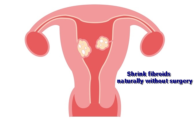 learning how to Shrink fibroids naturally without surgery